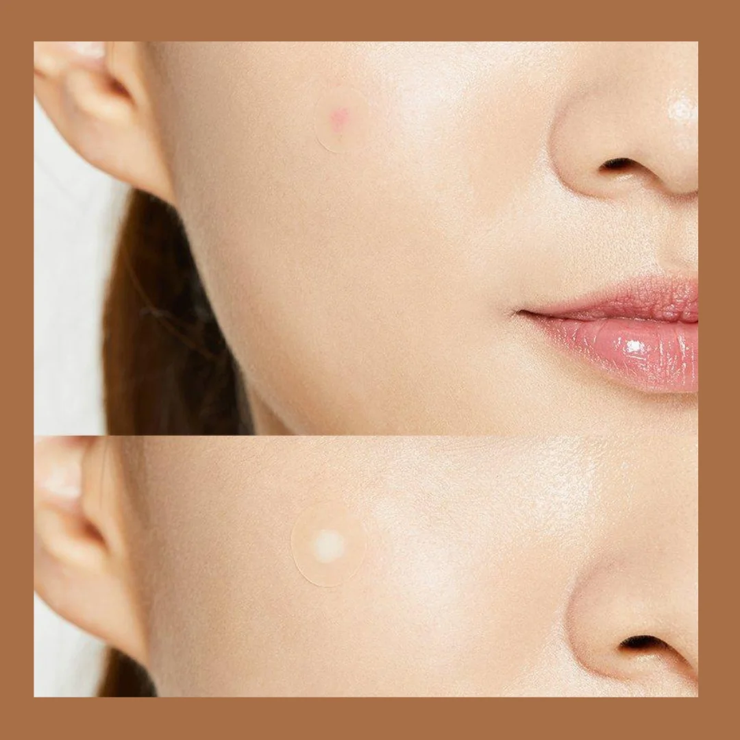 Cosrx Acne Pimple Master Patch (24pcs) (4) Cosrx Acne Pimple Master Patch (24pcs)